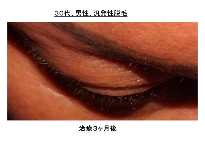 円形脱毛症　病院""